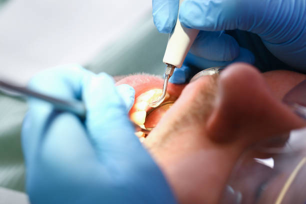 Best Dental Abscess Treatment in Holiday Valley, OH
